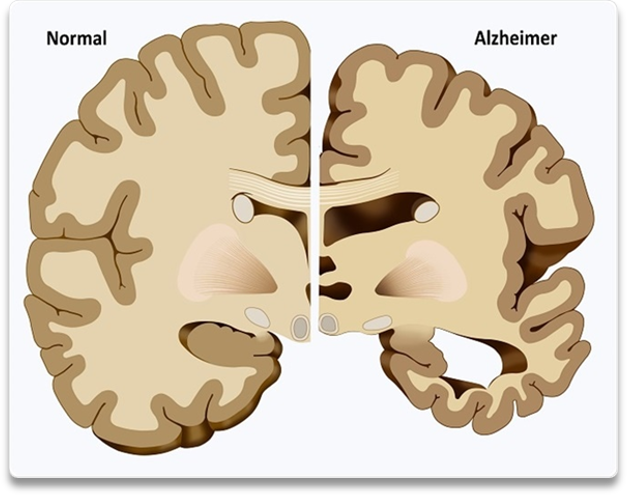 ¿COMO AFECTA AL CEREBRO? 15